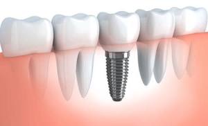 Dental-Implants